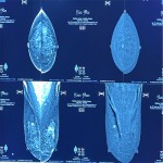 ماموگرافی-با-کنتراست